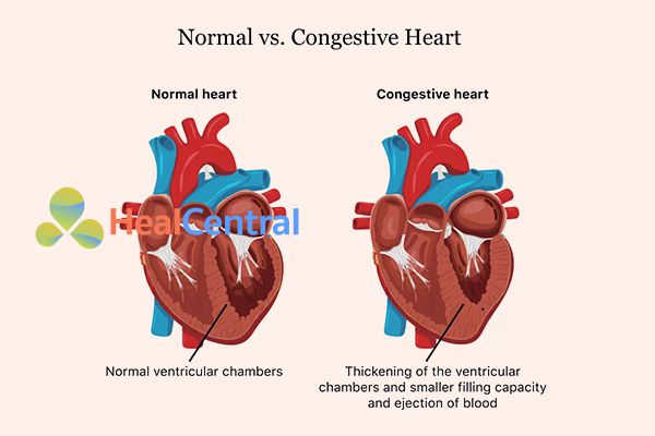 Tim của người bình thường và tim của bệnh nhân suy tim