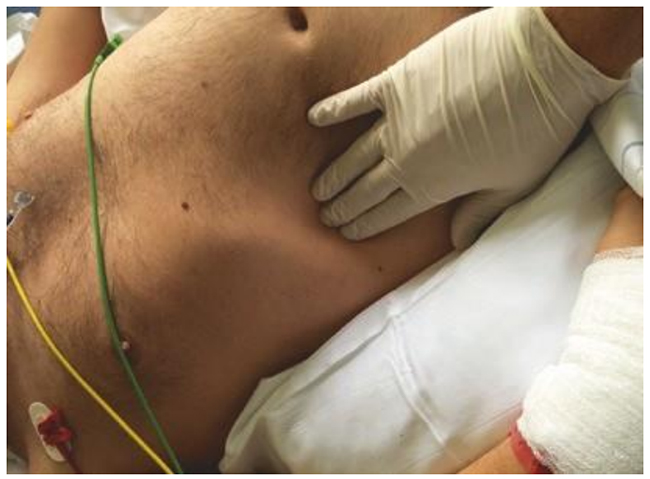 Sờ nắn bụng để phát hiện hoặc loại trừ xem bệnh nhân có đang chiến đấu với máy thở trong khi thở máy được kiểm soát hay không
