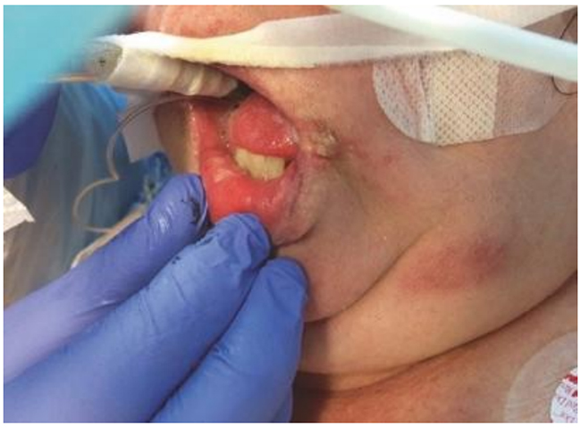 Nhiễm herpes labialis phản ứng ở một bệnh nhân bị viêm phổi do phế cầu khuẩn cộng đồng nặng và viêm màng phổi liên quan