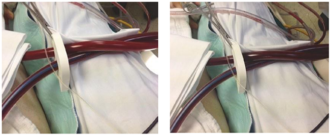 Kiểm tra màu máu máu trước và sau máy tạo oxy của mạch ECMO