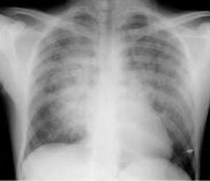 Hình ảnh phù phổi chụp X quang