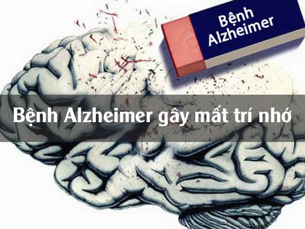 Bệnh Alzheimer gây mất trí nhớ