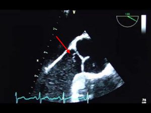 Lambl’s excrescence of aortic valve (Red arrow)
