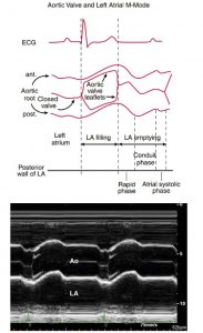 Hình 2-21 Ghi M-Mode tại van động mạch chủ. Sơ đồ (phía trên) và hình ảnh M-Mode (phía dưới) của van động mạch chủ, nhĩ trái và động mạch chủ lên ở người bình thường.