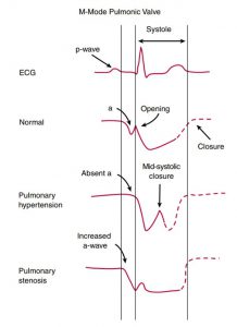 Hình 2-24 Hình dạng chuyển động của van động mạch phổi.