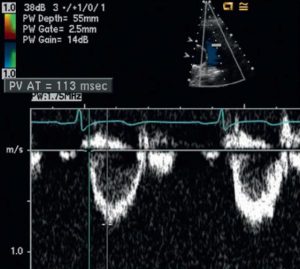 Hình 2-28 Đường cong vận tốc bình thường động mạch phổi.