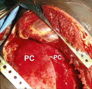 Hình 1: Hình ảnh 1⁄2 ngực trái trong khi mở ngực cấp cứu. Hình ảnh dập phổi (Pulmonary contusion, PC) tổn thương trên nhiều phân thùy phổi