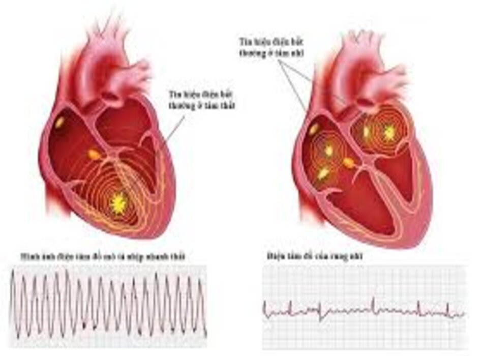 Nhịp Nhanh Tren Thất Do Vong Vao Lại Bac Sĩ Romulo F Baltazar