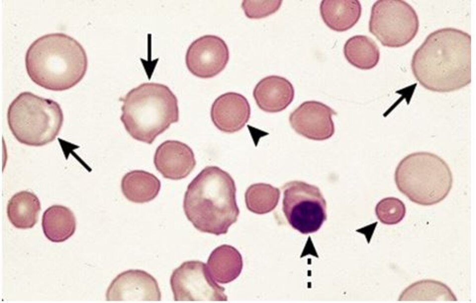 Hình 3: Lam máu ngoại vi từ một bệnh nhân bị thiếu máu tan máu tự miễn, Coombs (+). Hình ảnh có hồng cầu hình cầu, hồng cầu có nhân, hông cầu lớn đa sắc, thể hiện sự tăng hồng cầu lưới để đáp ứng với thiếu máu