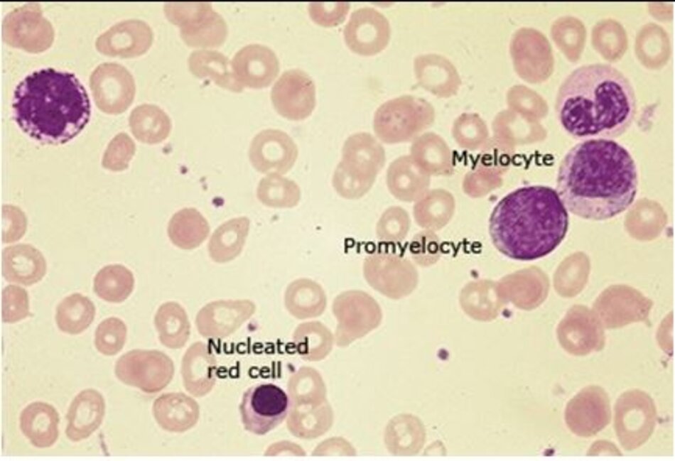 Hình 4: Lam máu ngoại vi có bạch cầu tăng, có các hồng cầu có nhân và bạch cầu chưa trưởng thành. Hiện tượng này xảy ra khi có thay thế tủy, thường trong xơ tủy nguyên phát hoặc phản ứng với các tình trạng như ung thư di căn.